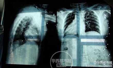 病危截图