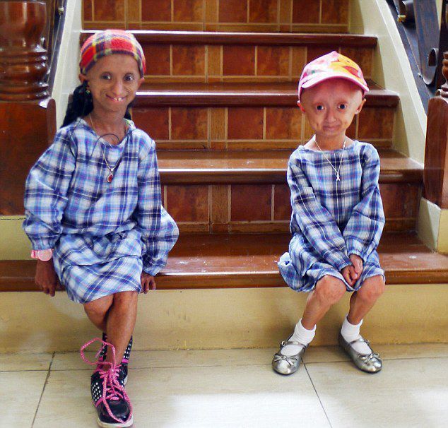 18岁菲女孩患早衰症 身体年龄高达144岁（图）