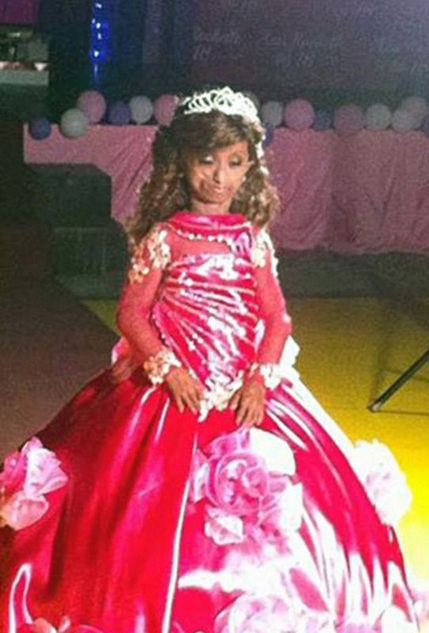 18岁菲女孩患早衰症 身体年龄高达144岁（图）