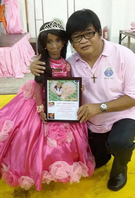 18岁菲女孩患早衰症 身体年龄高达144岁（图）