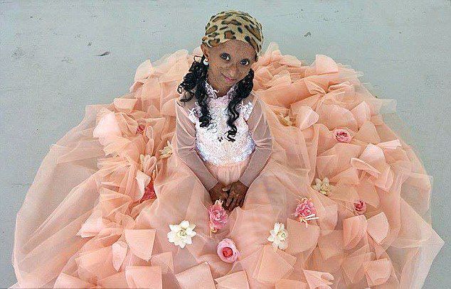 18岁菲女孩患早衰症 身体年龄高达144岁（图）